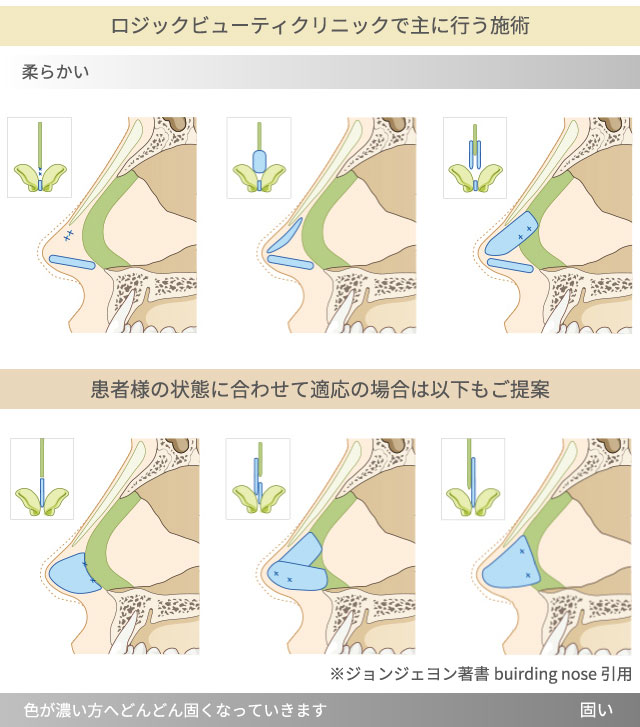 術後の鼻の中の状態