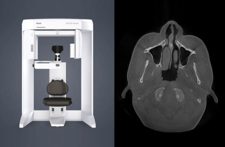 CT・鼻の内視鏡分析