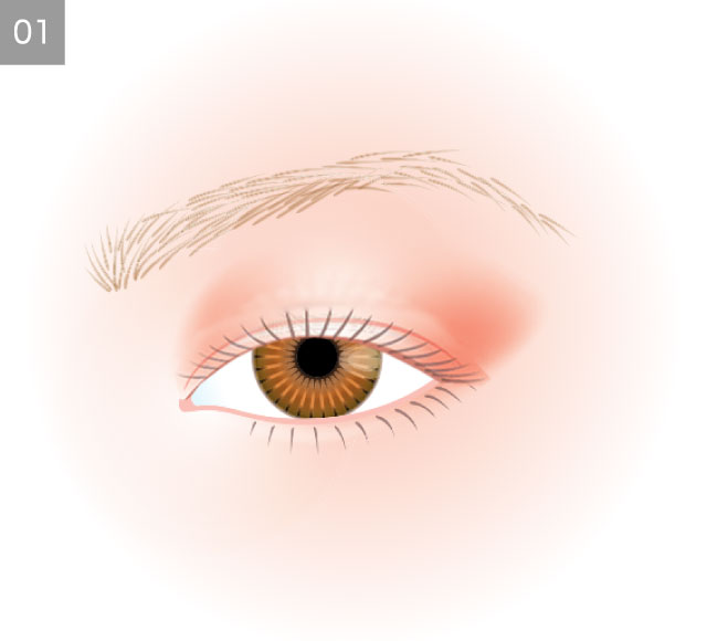 眼瞼下垂手術1