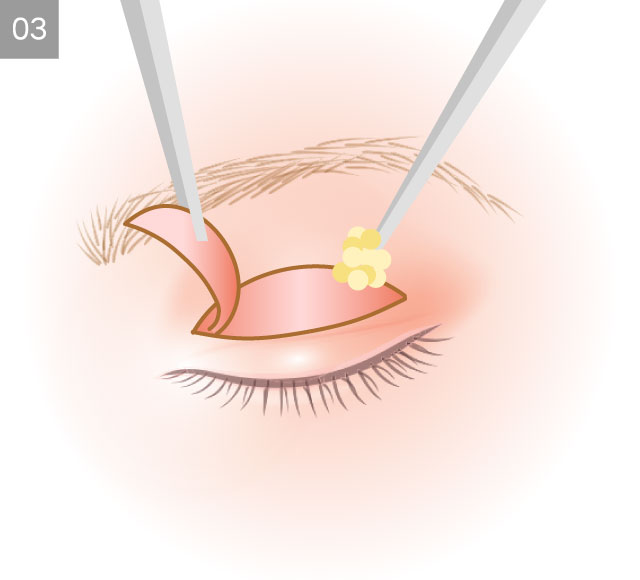眼瞼下垂手術3