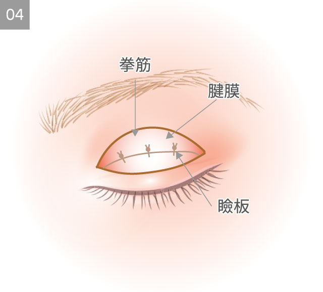 眼瞼下垂手術4