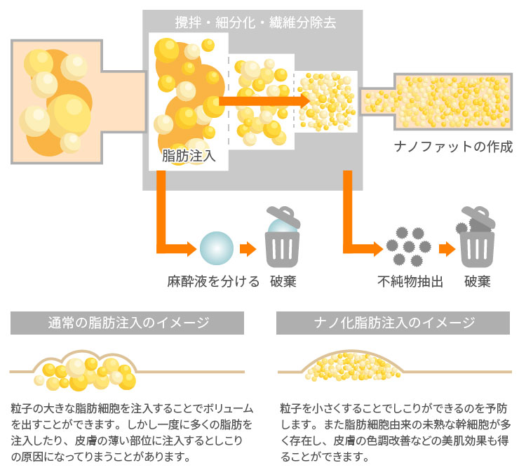 脂肪注入とナノファットの違い