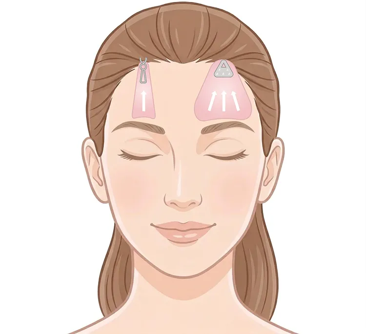 額リフトの特徴