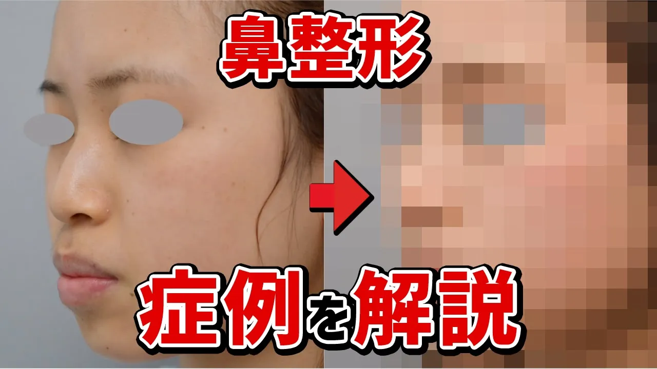 【鼻整形】症例写真で解説！！鼻中隔延長＋鼻尖形成術＋鼻プロテーゼ