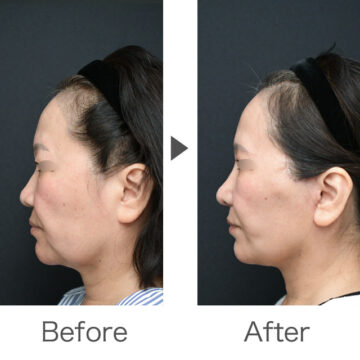 整鼻術/ペリカン手術